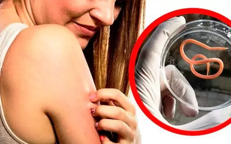 coceira e irritación debido a parasitos no corpo