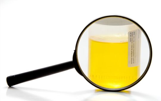 Exame de urina para diagnosticar esquistosomiase