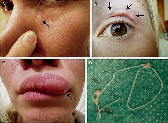 As principais manifestacións da dirofilariose na cara
